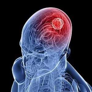 Мозговой удар