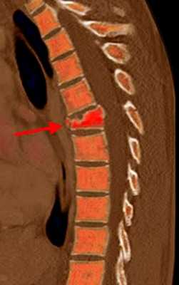 компрессионный перелом в цвете-2