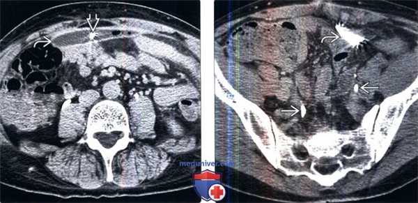 КТ, пиелография при травме мочеточника