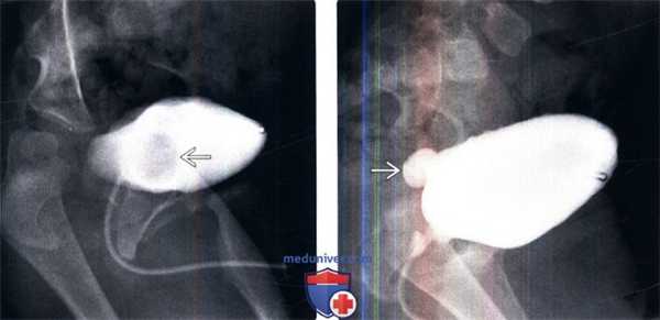 КТ, МРТ, урография при уретероцеле