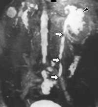 Стриктура мочеточника