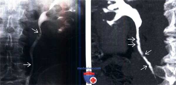 КТ, пиелография при кистозном уретерите