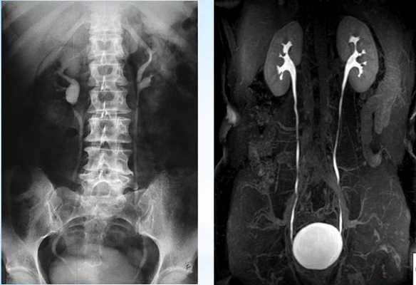 Пиелография перед оперативным вмешательством