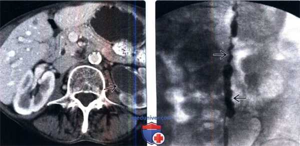 КТ, пиелография при кистозном уретерите