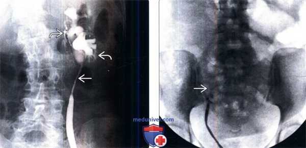 Ретроградная пиелография при стриктуре мочеточника