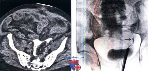 КТ, пиелография при травме мочеточника