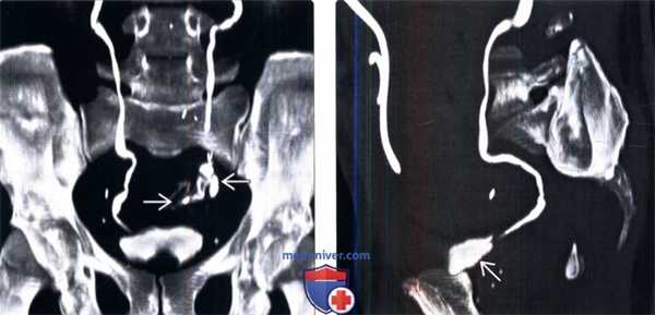 КТ, пиелография при травме мочеточника