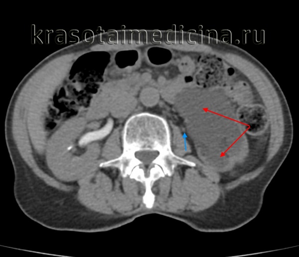 Травма мочеточника