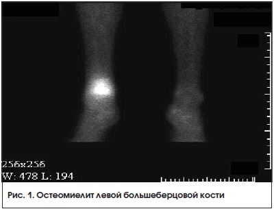 Рис. 1. Остеомиелит левой большеберцовой кости