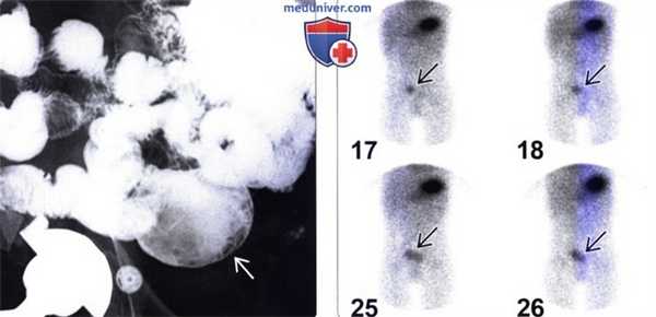 Рентгенограмма, КТ, УЗИ при дивертикуле Меккеля