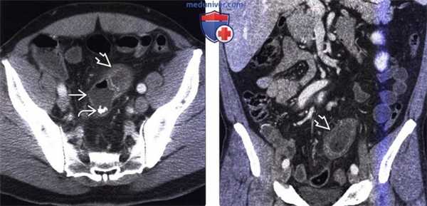 Рентгенограмма, КТ, УЗИ при дивертикуле Меккеля