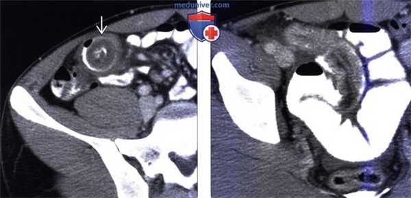 Рентгенограмма, КТ, УЗИ при дивертикуле Меккеля