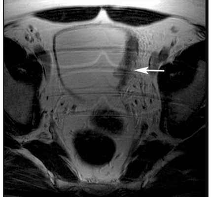 Рак мочевого пузыря на стадии T2b