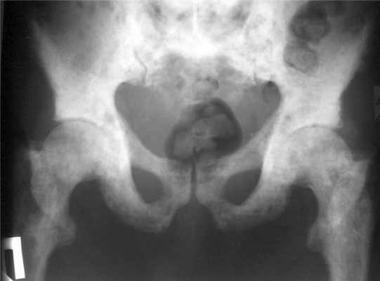 В каких случаях используют цистографию