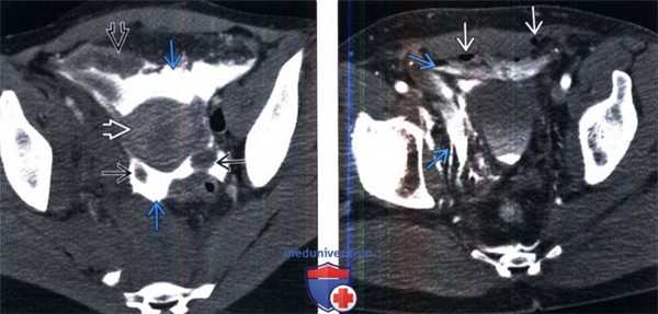 КТ, цистография при травме мочевого пузыря