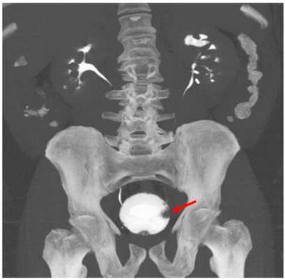 Контрастная компьютерная томография