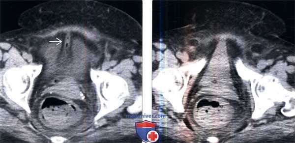 Методы лучевого обследования мочевого пузыря