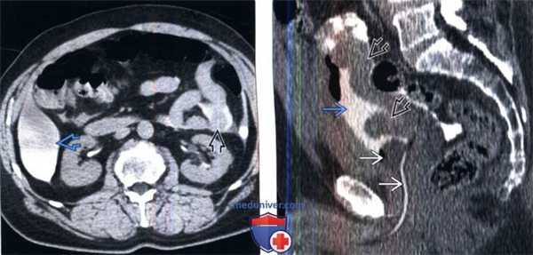 КТ, цистография при травме мочевого пузыря