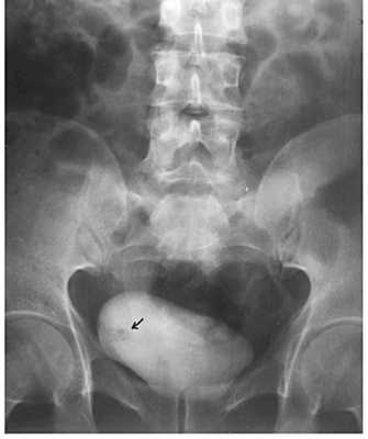 Рентгенологическая диагностика рака мочевого пузыря