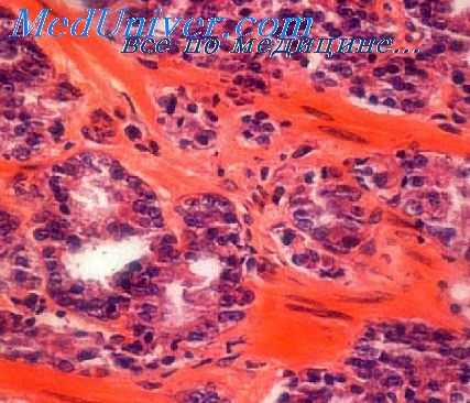 аденома простаты