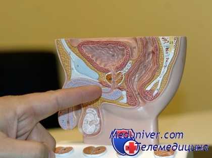 выявление аденомы простаты