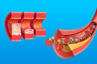 Основные факторы риска развития атеросклероза