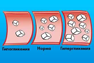 Факторы риска развития атеросклероза