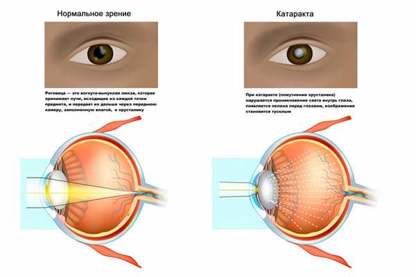 Катаракта.jpg