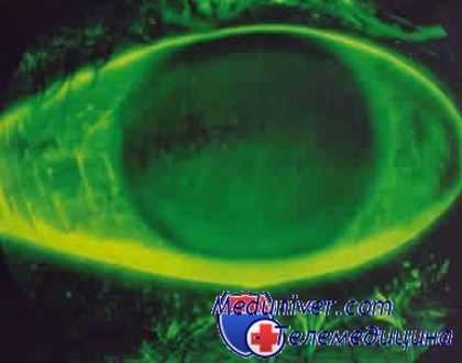 куриная слепота