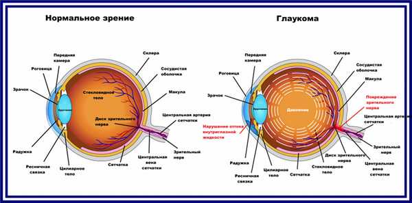 Глаукома.jpg