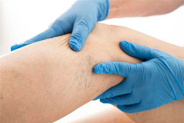 Тромбоз глубоких вен