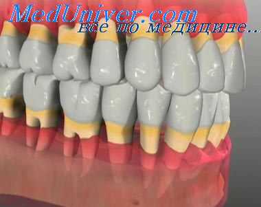 периодонтит