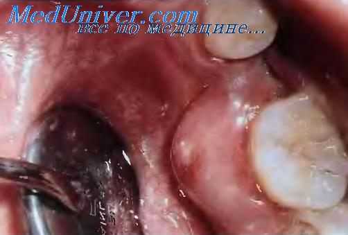 гингивотомия при перидонтальном абсцессе