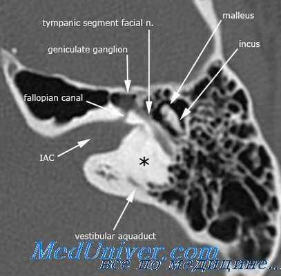 гнойный лабиринтит