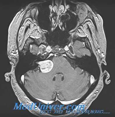 невоспалительные поражения лабиринта