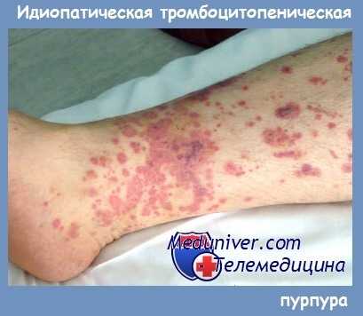 Сыпь при идиопатической тромбоцитопенической пурпуре