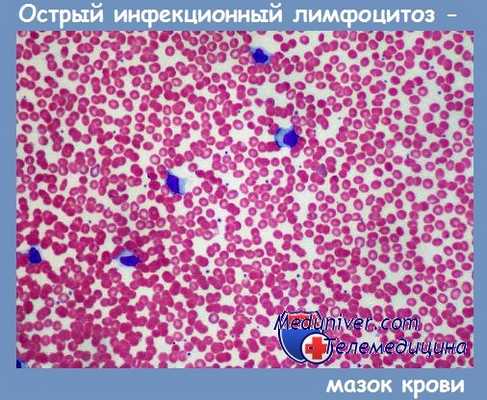мазок крови при остром инфекционном лимфоцитозе