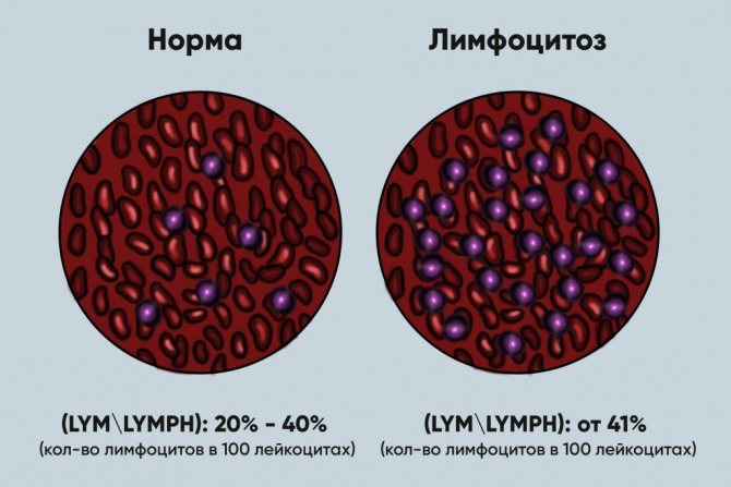 Лимфоцитоз: норма и патология