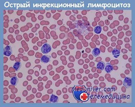 Острый инфекционный лимфоцитоз