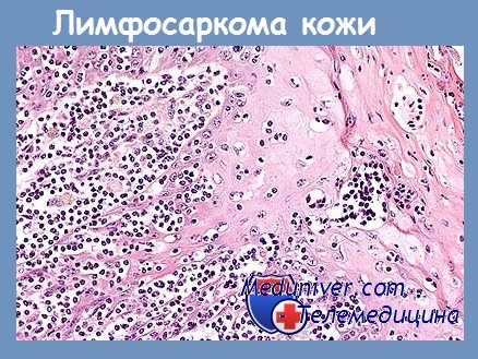 Лимфосаркома кожи