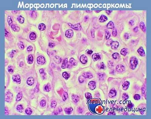 Лимфосаркома