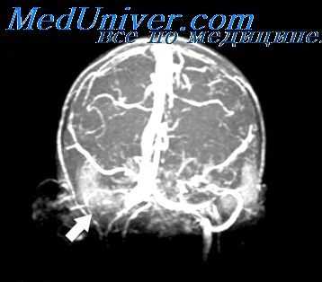 отогенный сепсис