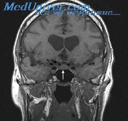 диагностика отогенного сепсиса
