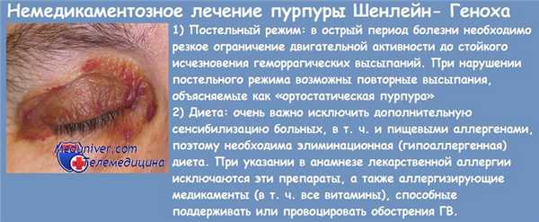 Лечение болезни Шенлейн-Геноха