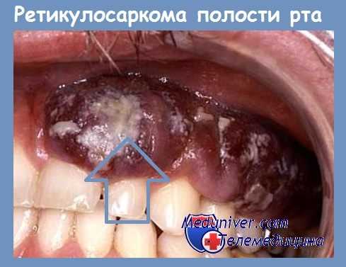 Ретикулосаркома полости рта
