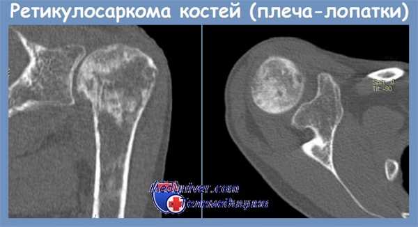 Ретикулосаркома костей
