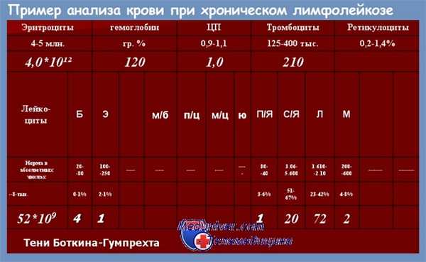 Анализ крови при хроническом лимфолейкозе
