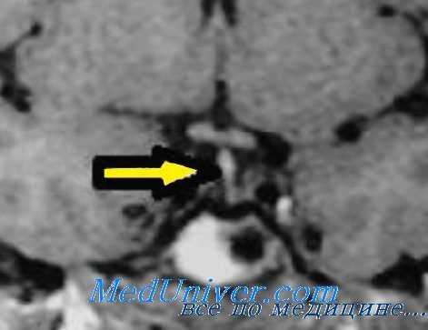 гипопитуитаризм