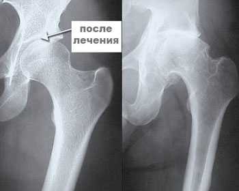 rentgen tazobedrenogo sustava doposle