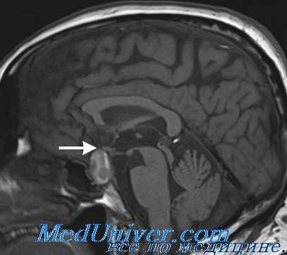 исследования при гипопитуитаризме